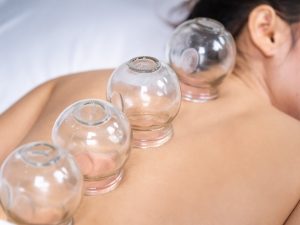 cupping therapy Melbourne